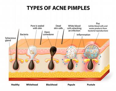 Guide to Adult Acne